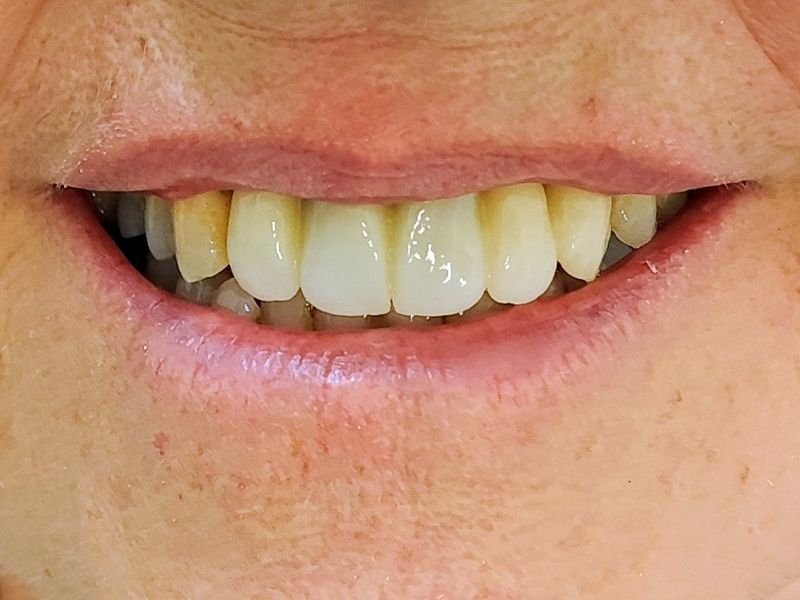 Sonrisa después del tratamiento