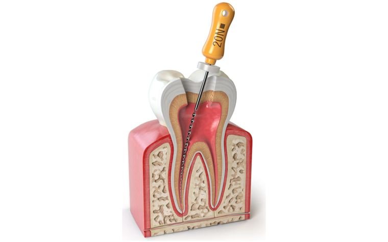 Tratamiento de endodoncia con apoyo radiográfico